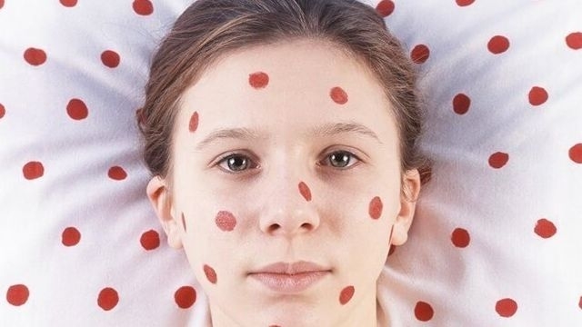 Чем смыть фукорцин с кожи: лучшие способы удалить пятна с кожи рук, лица и других поверхностей